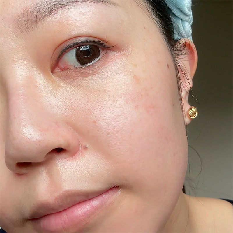 How my skin looks after a Medicube AGE-R Booster-H session